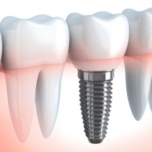 Tooth human implant (done in 3d graphics)